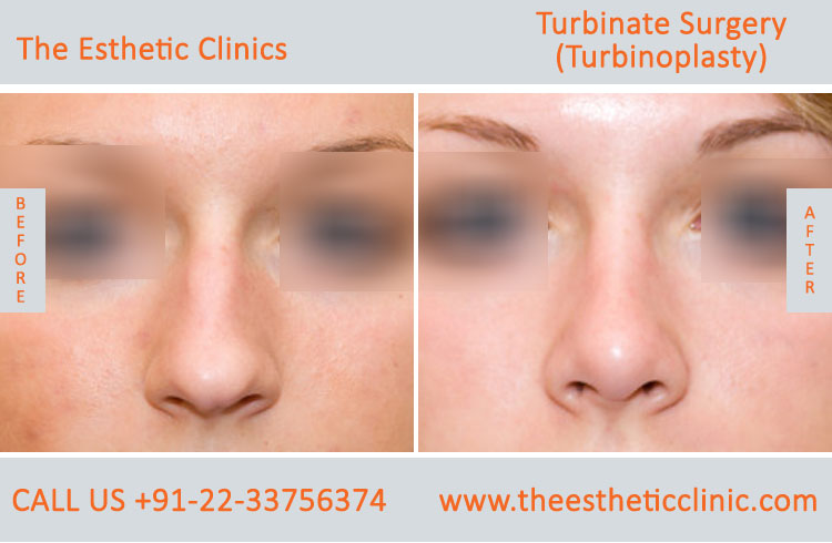 Turbinate Surgery, Turbinoplasty before after photos in mumbai india (4)